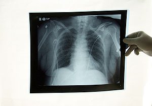 Комп'ютерна томографія легень