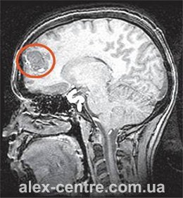 МРТ мозку з контрастом
